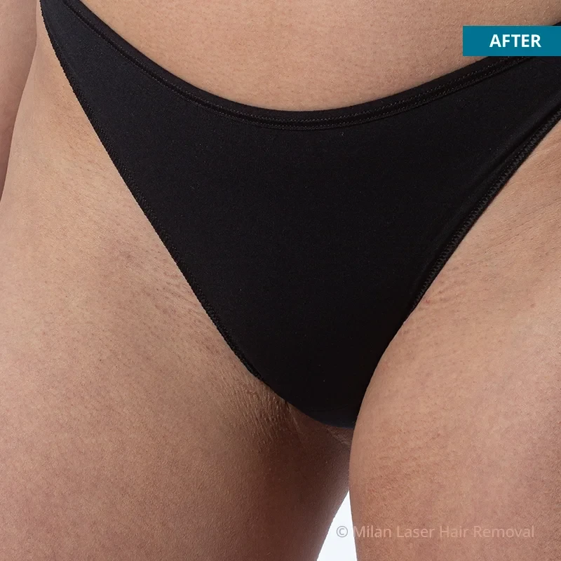 Before and after preview for bikini