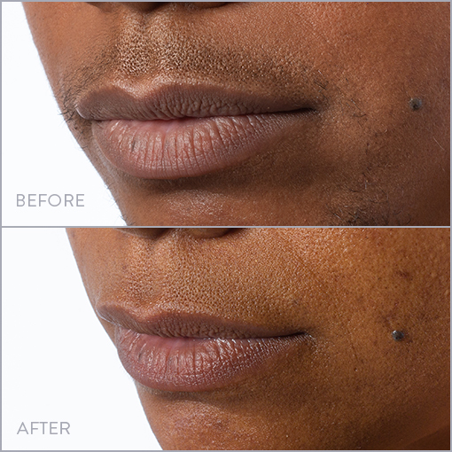 Lip and Chin Laser Hair Removal Photo, Before & After